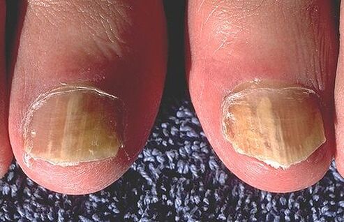 Dermatofüüdid mõjutatud küüned
